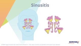 All SMART images are licensed under Creative Commons Attribution 4.0 – Share, adapt, and enhance your presentations with the power of open collaboration.
Sinusitis
 