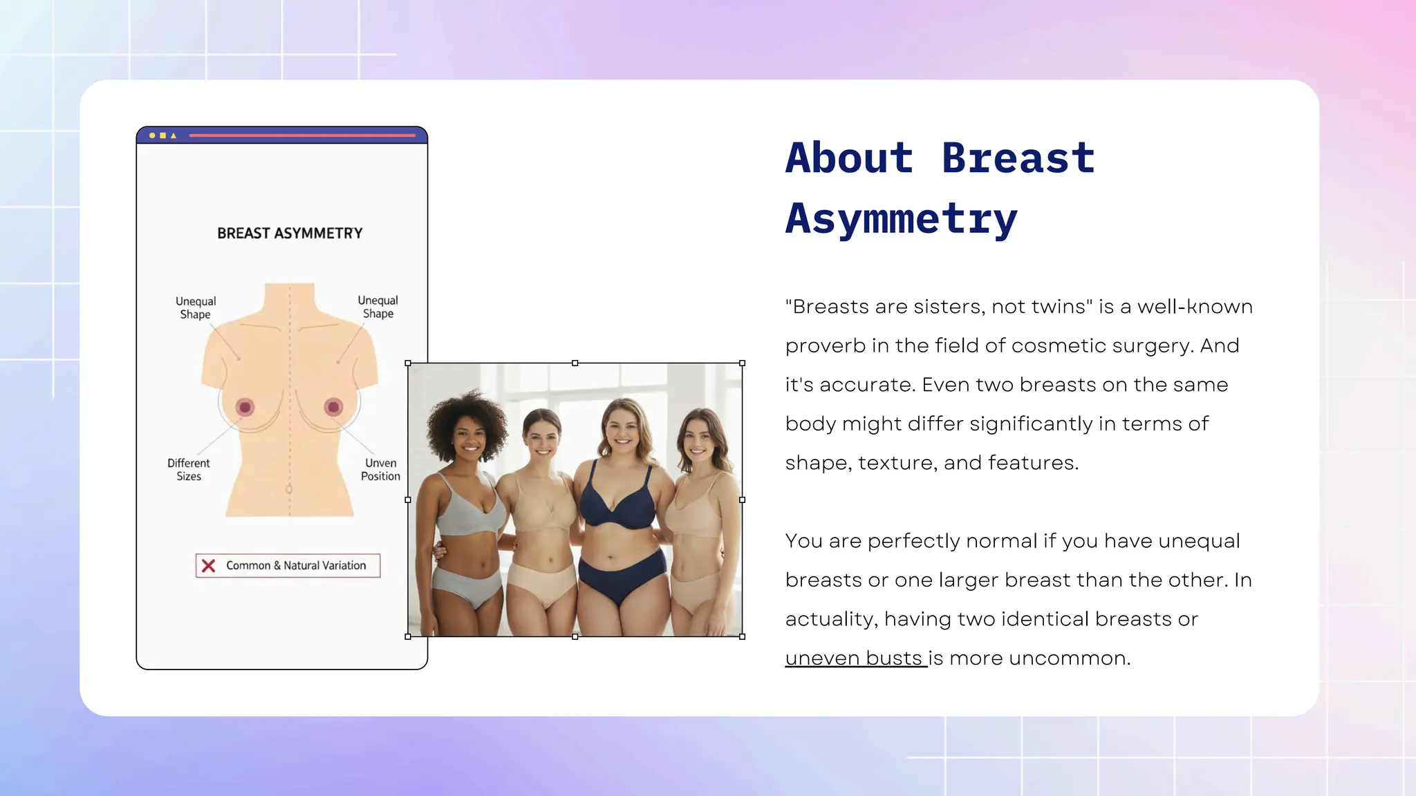 About Breast
Asymmetry
"Breasts are sisters, not twins" is a well-known
proverb in the field of cosmetic surgery. And
it's accurate. Even two breasts on the same
body might differ significantly in terms of
shape, texture, and features.
You are perfectly normal if you have unequal
breasts or one larger breast than the other. In
actuality, having two identical breasts or
uneven busts is more uncommon.
 