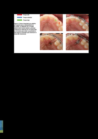 Torque	alto
                      Torque	estándar
                      Torque	bajo

     Figura	6.	Canino	impactado	por	palatino	
     sin	espacio	para	su	alineamiento	en	
     la	arcada.	La	utiliación	de	un	muelle	
     abierto	entre	incisivo	lateral	y	premolar	
     condicionó	la	selección	de	un	torque	bajo	
     en	el	incisivo	para	evitar	su	protrusión	y	
     alto	torque	en	premolar	para	favorecer	el	
     desarrollo	transversal.




                                               
   
 
      
   
   
 
     
 
     
   
   
                                               
   
    
   
   
   
   
   
   
   
   
   




         El torque bajo es de elección en              en los inferiores. Hay que hacer,                 aumentando el espacio habitable
     los incisivos inferiores cuando se                con obstante, algunas puntualiza-                 para a lengua en un intento de
     planifique la utilización de dispo-               ciones:                                           favorecer su ascenso y normaliza-
     sitivos de avance mandibular tipo                     En los casos en que la creación               ción neuromuscular para conseguir
     Herbst™ o Forsus™ y se preten-                    de resalte esté comprometido, será                el cierre de la mordida (Fig.5).
     de neutralizar la vestibuloversión                preferible la utilización de un tor-
     coronal generada por la fuerza      
         
   que 
alto en 
incisivos
 superiores Fig.6
                                                        
     
 
       
 
       
 
 Fig.6y           trataMIentos con
     mesial.                              
        
                                                   
                                                       torque 
 estándar

 o
 bajo 
 torque en
                                                         
 
      
 
           
      
 Fig.6
                                                                                             Fig.6     extraccIones
                                         
              
 
 
 
 
           
 
 
 
 
 
 
            
    
                                                                                                          
  
   
 
       
         La corrección de curvas de                    inferiores con el fin de generar
     Spee muy profundas en el trata-
              
                                                       un resalte positivo 
independien- 
                                                         
 
 
 
 
 
 
             
 
 
 
           
     
                                                                                                             Uno de los 
 principales pro-
                                                                                                               
   
   
                                                                                                                       

     miento de la sobremordida aumen-                  temente del uso de elásticos de                   blemas que se plantean en los
     tada mediante arcos con anticurva                 Clase III.                                        tratamientos con extracciones es
     debe ir acompañada de brackets de                                                                   la pérdida de torsión de los dien-
     bajo torque en incisivos inferio-                 MordIdas abIertas                                 tes anteriores. La aplicación de
     res para evitar su vestibulización                                                                  fuerzas excesivas (superiores a los
     (Fig.4).                                              En el tratamiento de las mordi-               150 grms) o el empleo de arcos de
         De cualquier forma, la posi-                  das abiertas la selección del torque              trabajo de sección (arcos no rec-
     ción de cada uno de los dientes                   debe ir dirigida a evitar la pro-                 tangulares), diámetro (por debajo
     individualmente debe primar en la                 trusión de los dientes anteriores,                de 0.019” x 0.025”) o materiales
     selección de la prescripción inde-                favoreciendo el desarrollo trans-                 inadecuados (arcos con alto módu-
     pendientemente de la maloclusión                  versal de las arcadas. La vestibu-                lo de elasticidad)29 puede generar
     en la que esté englobada.                         loversión de los dientes anteriores               una pérdida de torque con conse-
                                                       conlleva un aumento del ángulo                    cuencias graves en la consecución
     MaLocLusIones de                                  interincisivo con la consiguiente                 de nuestros objetivos funcionales
     cLase III                                         apertura de la mordida. Utilizan-                 y estéticos. La pérdida de torsión
                                                       do prescripciones de bajo torque                  de los dientes anteriores generará
         En general el tratamiento de las              tanto en incisivos superiores (+12º               un aumento de la sobremordida
     Clase III conlleva la utilización de              torque,+3ºang) como en inferiores                 y un acortamiento de la longitud
     elásticos intermaxilares que pro-                 (-6º torque, 0ºang) reducimos la                  de la arcada, reduciendo el resalte
     muevan la creación de resalte. En                 tendencia protrusiva. Si además lo                necesario para poder alcanzar una
     este sentido, para neutralizar la                 combinamos con brackets de alto                   Clase I. Para prevenir la pérdi-
     tendencia a la retroinclinación de                torque en caninos y premolares                    da de torsión anterior la prescrip-
     los incisivos inferiores y al exceso              superiores (+6º torque, +8º ang                   ción de elección en los casos con
     de torsión de los superiores por el               y -4º torque, 0º ang. respectiva-                 extracciones será torque alto tanto
     uso de elásticos, la elección idónea              mente) y caninos inferiores (+7º                  en incisivos como en caninos de
     debe contemplar bajo torque en los                torque, +3º ang) potenciamos el                   ambas arcadas. También en los
     incisivos superiores y alto torque                desarrollo transversal de la arcada               casos de extracción, la versatili-




46
 