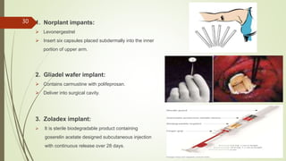 1. Norplant impants:
 Levonergestrel
 Insert six capsules placed subdermally into the inner
portion of upper arm.
2. Gliadel wafer implant:
 Contains carmustine with polifeprosan.
 Deliver into surgical cavity.
3. Zoladex implant:
 It is sterile biodegradable product containing
goserelin acetate designed subcutaneous injection
with continuous release over 28 days.
30
 