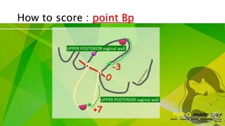 POP-Q made easy | PPSX