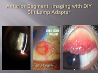 Smartphone ophthalmic imaging