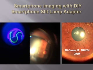 Smartphone ophthalmic imaging