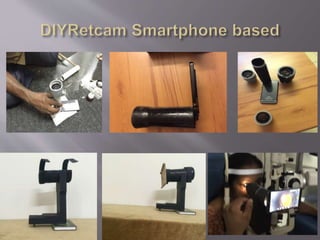 Smartphone ophthalmic imaging