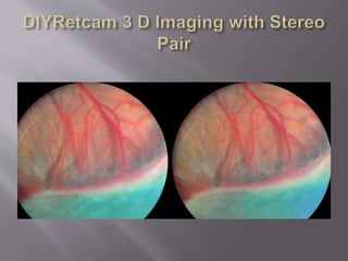 Smartphone ophthalmic imaging