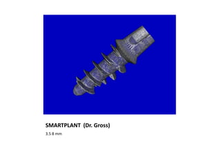 SMARTPLANT (Dr. Gross)
3.5 8 mm
 