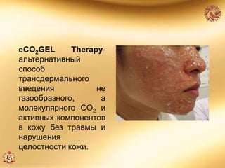 eCO2GEL Therapy-
альтернативный
способ
трансдермального
введения не
газообразного, а
молекулярного CO2 и
активных компонентов
в кожу без травмы и
нарушения
целостности кожи.
 