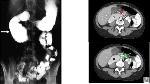 sma syndrome Superior mesenteric artery syndrome | PPTX