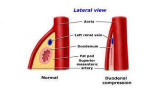 sma syndrome Superior mesenteric artery syndrome | PPTX