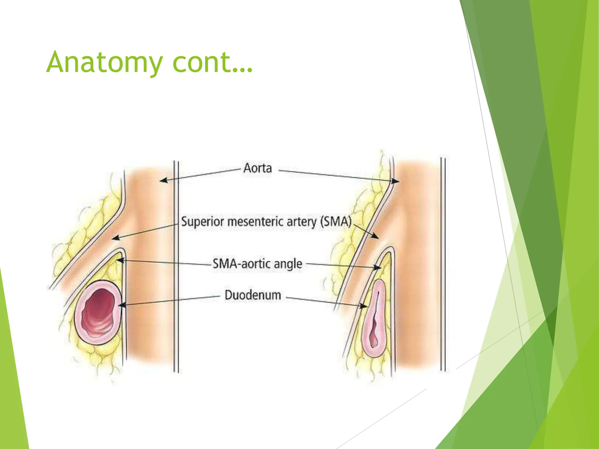 SMA SYNDROME as a surgical point of view.pptx