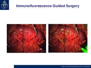 Immunofluorescence Guided Surgery

Radboud University Nijmegen Medical Center, The Netherlands

 