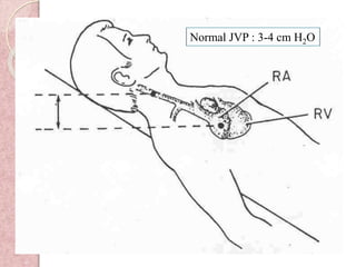 Normal JVP : 3-4 cm H2O
 