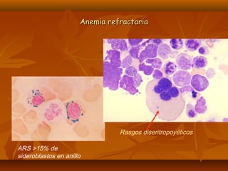 AAnneemmiiaa rreeffrraaccttaarriiaa 
ARS >15% de 
sideroblastos en anillo 
Rasgos diseritropoyéticos 
 