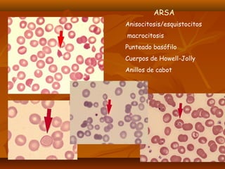 ARSA 
Anisocitosis/esquistocitos 
macrocitosis 
Punteado basófilo 
Cuerpos de Howell-Jolly 
Anillos de cabot 
 