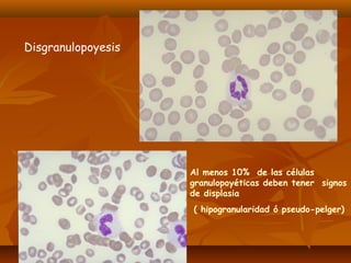 Disgranulopoyesis 
Al menos 10% de las células 
granulopoyéticas deben tener signos 
de displasia 
( hipogranularidad ó pseudo-pelger) 
 