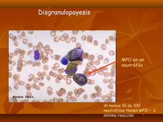 MPO en un 
neutrófilo 
Al menos 10 de 100 
neutrófilos tienen MPO – ó 
mínima reacción 
Disgranulopoyesis 
 
