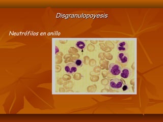 DDiissggrraannuullooppooyyeessiiss 
Neutrófilos en anillo 
 