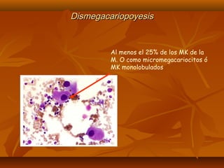DDiissmmeeggaaccaarriiooppooyyeessiiss 
Al menos el 25% de los MK de la 
M. O como micromegacariocitos ó 
MK monolobulados 
 