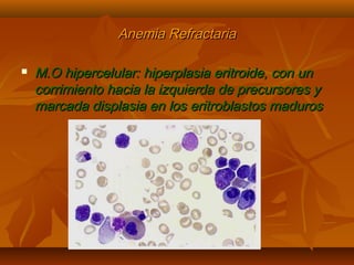 AAnneemmiiaa RReeffrraaccttaarriiaa 
 MM..OO hhiippeerrcceelluullaarr:: hhiippeerrppllaassiiaa eerriittrrooiiddee,, ccoonn uunn 
ccoorrrriimmiieennttoo hhaacciiaa llaa iizzqquuiieerrddaa ddee pprreeccuurrssoorreess yy 
mmaarrccaaddaa ddiissppllaassiiaa eenn llooss eerriittrroobbllaassttooss mmaadduurrooss 
 