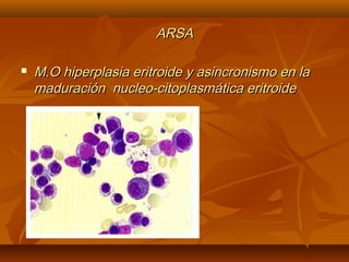 AARRSSAA 
 MM..OO hhiippeerrppllaassiiaa eerriittrrooiiddee yy aassiinnccrroonniissmmoo eenn llaa 
mmaadduurraacciióónn nnuucclleeoo--cciittooppllaassmmááttiiccaa eerriittrrooiiddee 
 