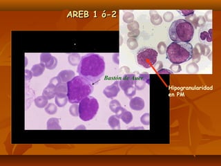 AARREEBB 11 óó--22 
Bastón de Auer 
Hipogranularidad 
en PM 
 