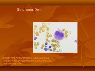 SSiinnddrroommee 55qq-- 
Ocurre mas frecuentemente en mujeres .Es 
una anomalía citogenética de buen pronóstico, 
cuando esta sola 
 