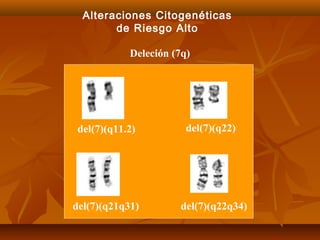 Alteraciones Citogenéticas 
de Riesgo Alto 
Deleción (7q) 
del(7)(q11.2) 
del(7)(q22) 
del(7)(q21q31) del(7)(q22q34) 
 