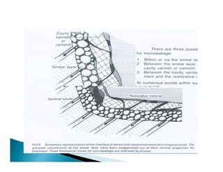 Smear Layer Modifications Smear layer | PDF