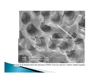 Smear Layer Modifications Smear layer | PDF