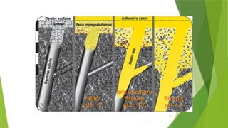 SMEAR LAYER IN ENDODONTICS AND CONSERVATIVE DENTISTRY | PPTX