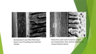 Smear Layer Modifications SMEAR LAYER IN ENDODONTICS AND CONSERVATIVE DENTISTRY | PPTX