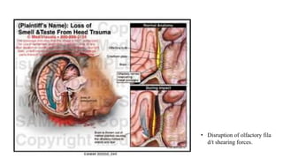 • Disruption of olfactory fila
d/t shearing forces.
 