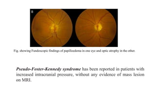 Pseudo-Foster-Kennedy syndrome has been reported in patients with
increased intracranial pressure, without any evidence of mass lesion
on MRI.
Fig. showing Fundoscopic findings of papilloedema in one eye and optic atrophy in the other.
 
