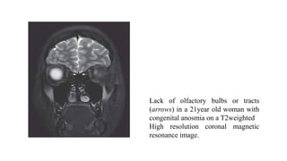Lack of olfactory bulbs or tracts
(arrows) in a 21year old woman with
congenital anosmia on a T2weighted
High resolution coronal magnetic
resonance image.
 