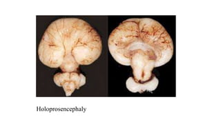 Holoprosencephaly
 