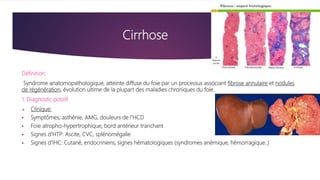 Cirrhose
Définition:
Syndrome anatomopathologique, atteinte diffuse du foie par un processus associant fibrose annulaire et nodules
de régénération, évolution ultime de la plupart des maladies chroniques du foie.
1. Diagnostic positif
 Clinique:
 Symptômes; asthénie, AMG, douleurs de l’HCD
 Foie atropho-hypertrophique, bord antérieur tranchant
 Signes d’HTP: Ascite, CVC, splénomégalie
 Signes d’IHC: Cutané, endocriniens, signes hématologiques (syndromes anémique, hémorragique..)
 