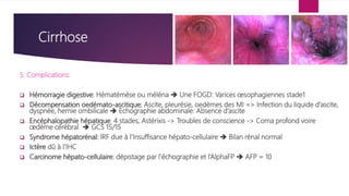 Cirrhose
5. Complications:
 Hémorragie digestive: Hématémèse ou méléna  Une FOGD: Varices œsophagiennes stade1
 Décompensation oedémato-ascitique; Ascite, pleurésie, oedèmes des MI => Infection du liquide d’ascite,
dyspnée, hernie ombilicale  Echographie abdominale: Absence d’ascite
 Encéphalopathie hépatique: 4 stades, Astérixis -> Troubles de conscience -> Coma profond voire
œdème cérébral  GCS 15/15
 Syndrome hépatorénal: IRF due à l’Insuffisance hépato-cellulaire  Bilan rénal normal
 Ictère dû à l’IHC
 Carcinome hépato-cellulaire: dépistage par l’échographie et l’AlphaFP  AFP = 10
 