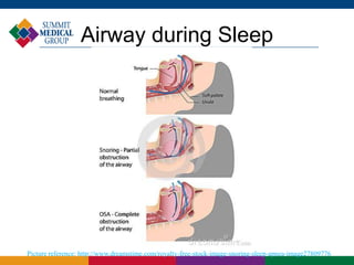 Snore Reference Can Snoring Harm Your Health? | PPTX