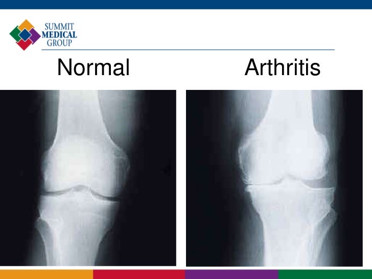 Living with Osteoarthritis of the Knee