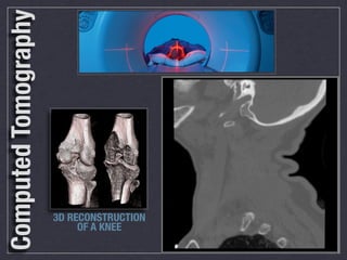 Computed Tomography
                               Develop your skills and expand your knowledge through a career path in:




                                                  We’re a dynamic team of medical professionals
                                                  working in an exciting downtown hospital in the heart

                                                  Join our team and you will be working in a fast-paced urban
                                                  health care environment that promotes job satisfaction,
                                                  continuing education and a commitment to providing the ﬁnest
                                                  imaging services available for superb patient care.
                                                  The medical Imaging team        We offer competitive packages
                                                  at St. Michael’s Hospital       along with comprehensive beneﬁts
                                                  provides the highest            including:

                                                  quality diagnostic services
                                                  to our patients. We are
                                                  an integral part of one of
                                                  Canada’s top teaching and
                                                  research hospitals, with
                                                  state of the art equipment, serving a diverse inner city patient
                                                  population.



                      3D RECONSTRUCTION
                           OF A KNEE
 