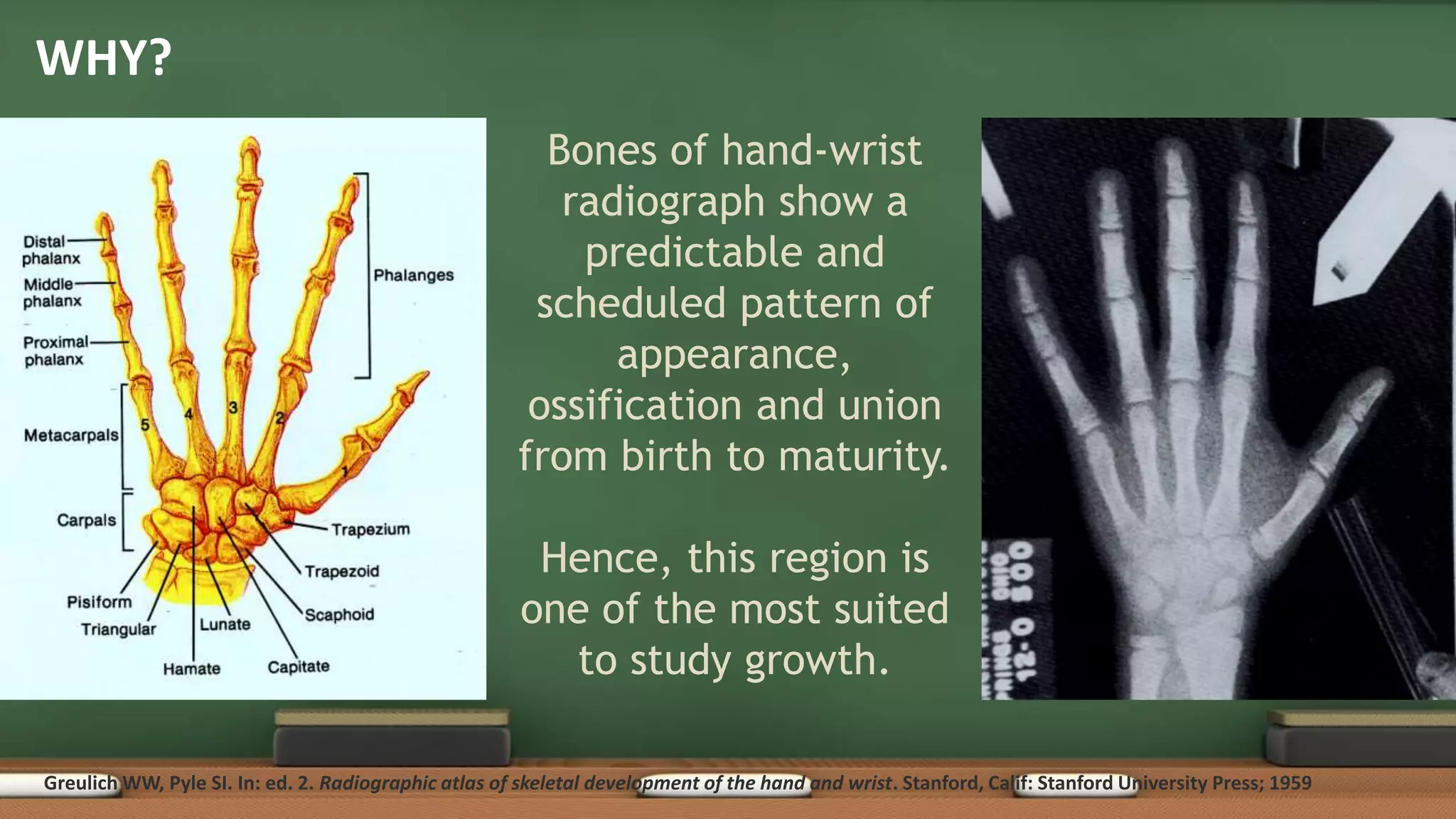 Skeletal Age Assessment and Maturity Indicators | PPTX