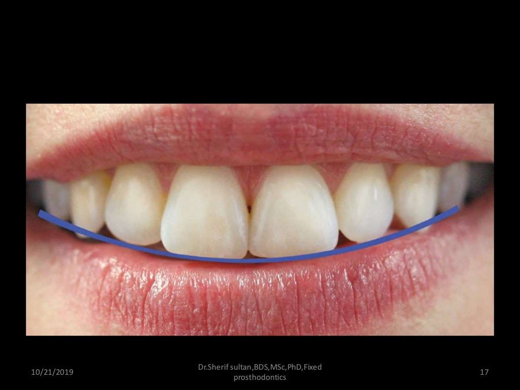 Smile analysis and digital smile design