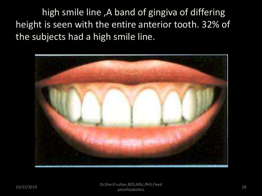 Smile analysis and digital smile design