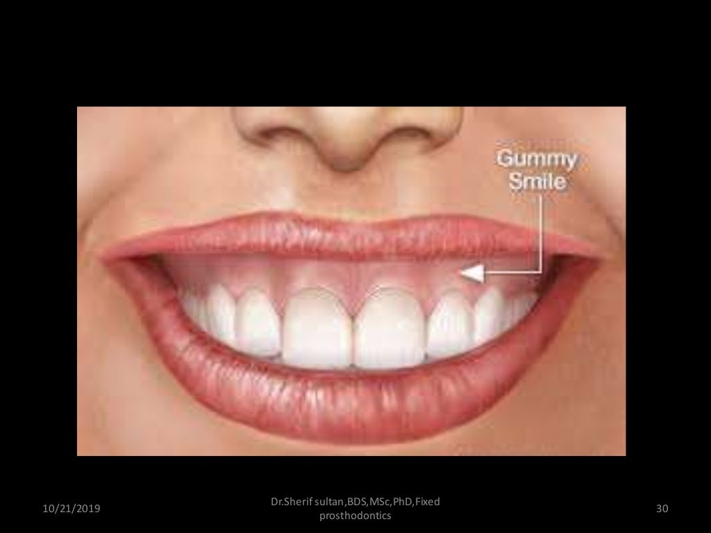 Smile analysis and digital smile design