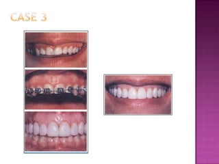 Smile analysis in vertical dimention:- factors to be considered when observed by orthodontist 