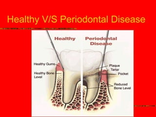 Healthy V/S Periodontal Disease 