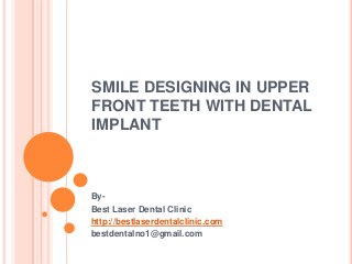 SMILE DESIGNING IN UPPER
FRONT TEETH WITH DENTAL
IMPLANT
By-
Best Laser Dental Clinic
http://bestlaserdentalclinic.com
bestdentalno1@gmail.com
 