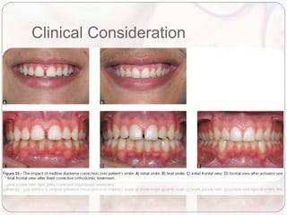 Smile Design Recession Smile design in orthodontics.pptx
