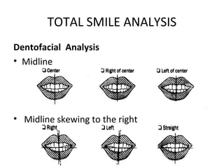 TOTAL SMILE ANALYSIS
Dentofacial Analysis
• Midline
• Midline skewing to the right
 