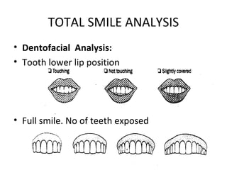 TOTAL SMILE ANALYSIS
• Dentofacial Analysis:
• Tooth lower lip position
• Full smile. No of teeth exposed
 